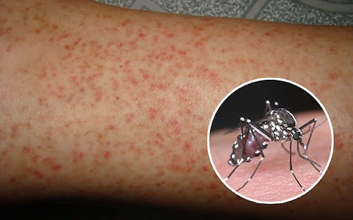 Tại sao sốt xuất huyết khỏe rồi tử vong?